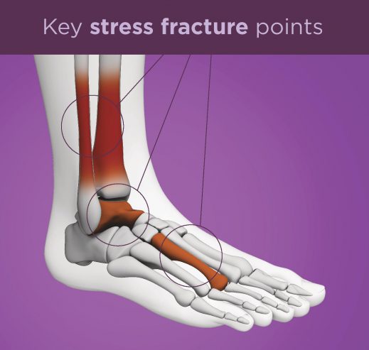 stress fracture definition