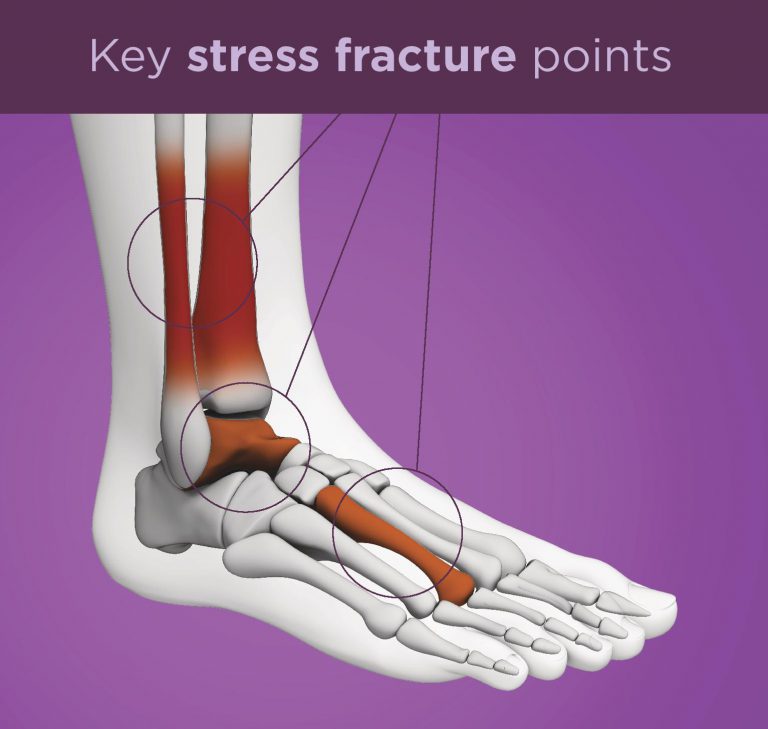 stress fractures literature review