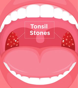 What Are Tonsil Stones Tonsilloliths Symptoms Treatment Upmc