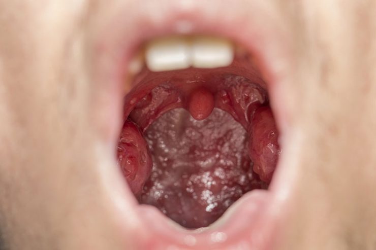 Does White Spots On Tonsils Mean Infection