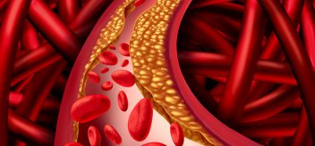 What Is Atherosclerosis?