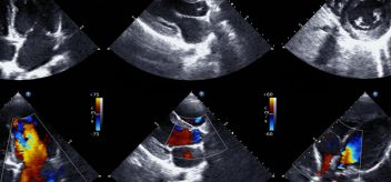 The results of an echocardiogram.