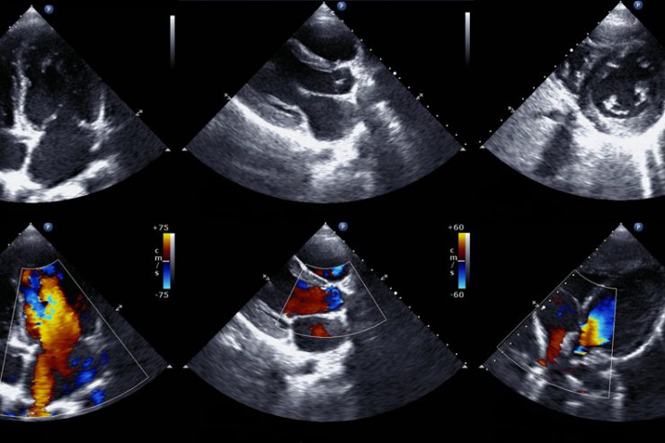 The results of an echocardiogram.