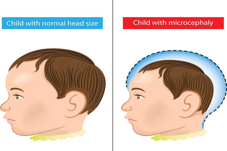 The Zika virus can lead to the birth defect microcephaly