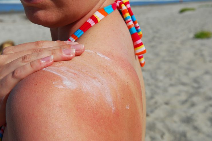 Learn how to tell the difference between sunburn and sun poisoning