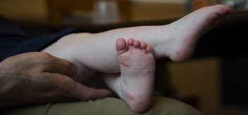 Hand, foot, and mouth disease is a common illness among children under age 5