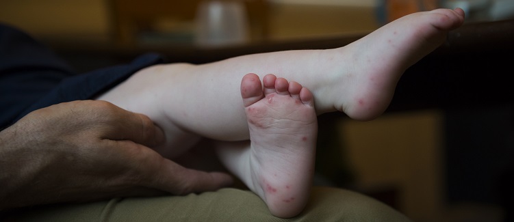 Hand, foot, and mouth disease is a common illness among children under age 5