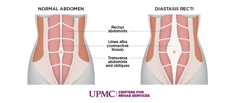 Learn more about diastis recti