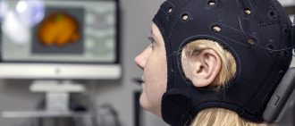 How Non-Invasive Brain Stimulation May Improve Stroke Therapy Outcomes