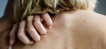 Lupus rash treatment