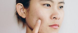 Hormonal Acne Treatment and Causes