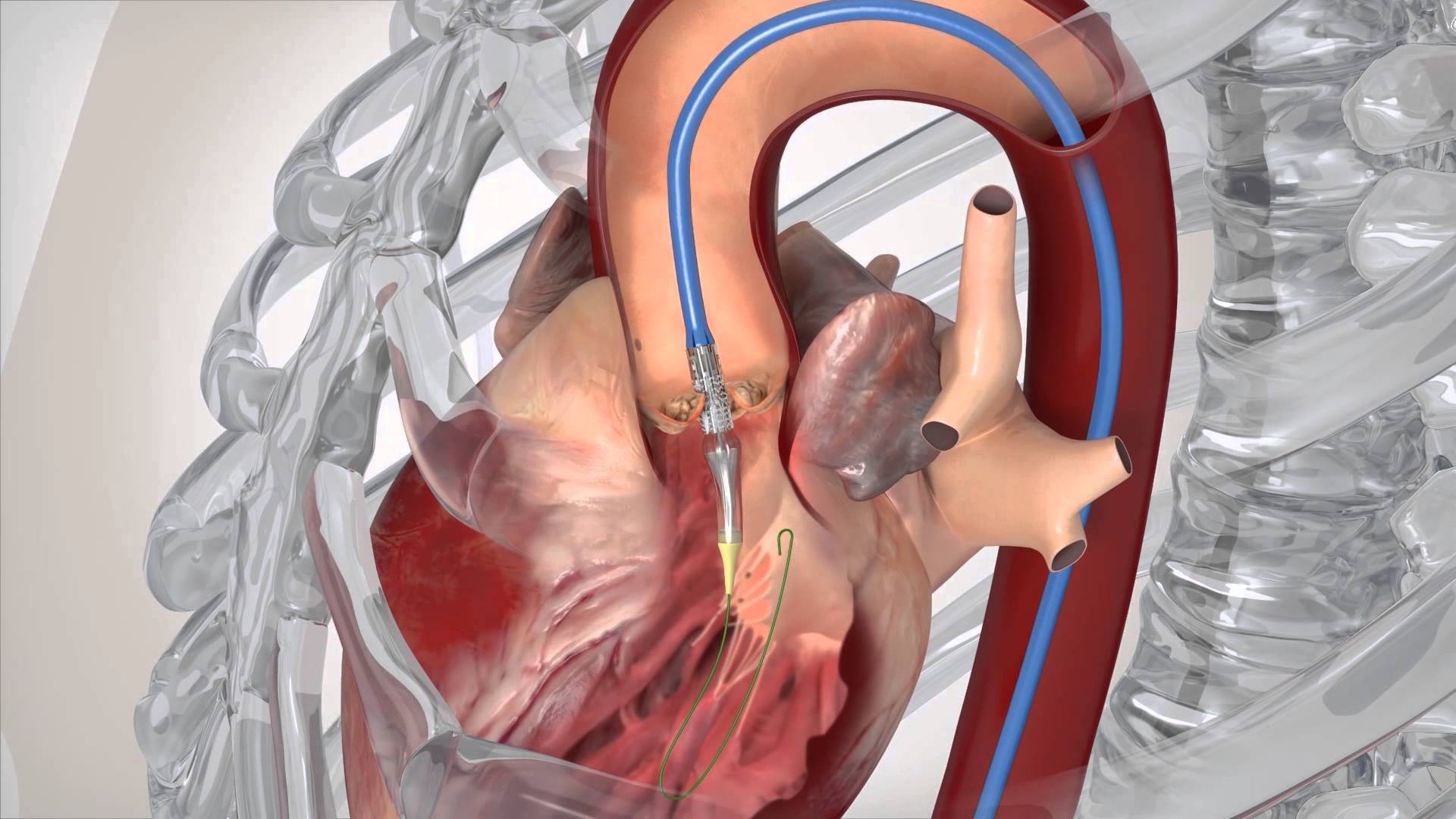 Narrowing Aortic Valve Can Be Treated Without Open Heart Surgery Upmc Healthbeat