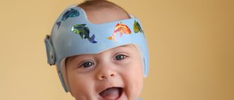What to Expect if Your Child Needs Molding Helmet Therapy