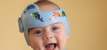 What to Expect if Your Child Needs Molding Helmet Therapy