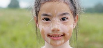 What to Know About Vitiligo in Children